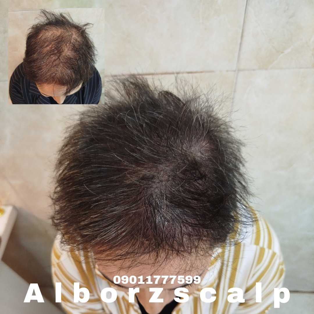 اسکالپ پوششی